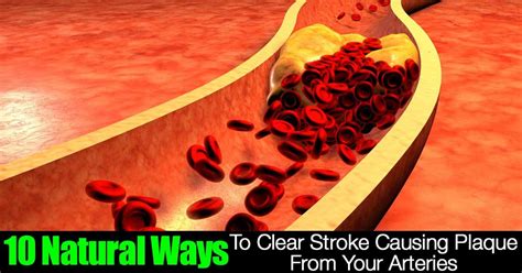 Maybe you would like to learn more about one of these? 10 Natural Ways To Clear Stroke Causing Plaque From Your ...