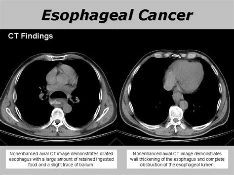 Esophageal Cancer Dr A Mohammadzadeh Thorasic Surgeon Esophageal