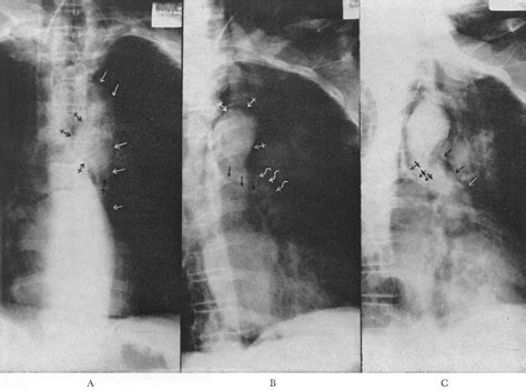 Diagnostic Carbon Dioxide Pneumomediastinography As An Extension Of