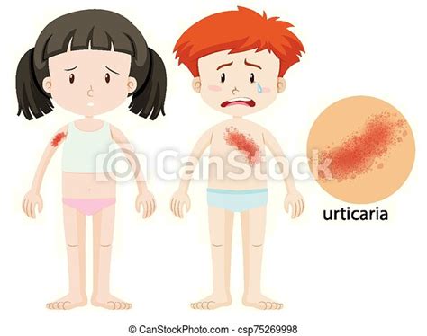 Diagram Showing Boy And Girl With Urticaria Illustration Canstock
