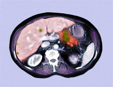 Metastatic Pancreatic Cancer Ct Scan Photograph By Du Cane Medical