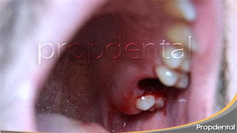 Efectos Secundarios De La Extracción Dental