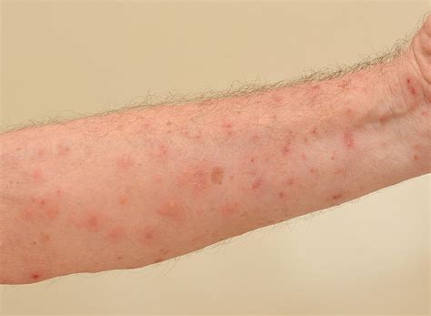 What Are Human Scabies And Norwegian Scabies Symptoms Causes And My