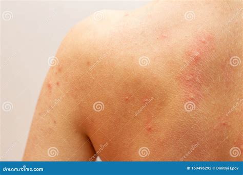 Urtikaria Allergie Auf Der Haut Stockfoto Bild Von Hintergrund