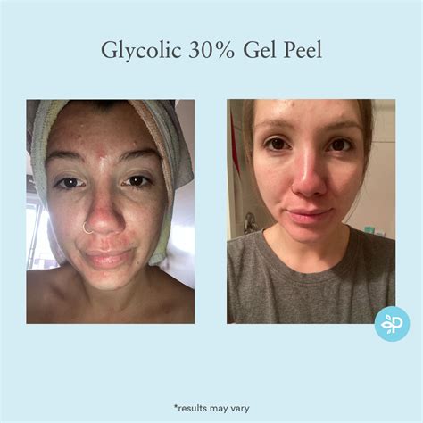 Glycolic 30 Gel Peel Chemical Peel Before And After Even Skin Tone