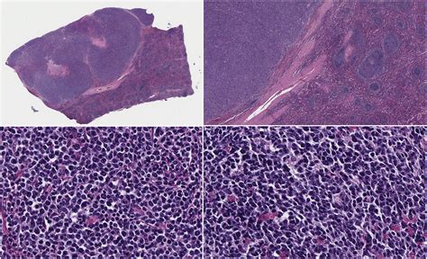 Follicular Lymphoma Transforming Into Diffuse Large B Cell Lymphoma In