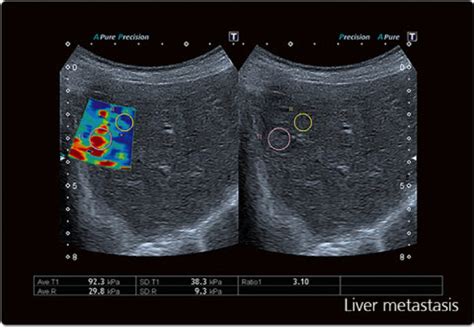 Liver Fibrosis Scan Direct Endoscopy