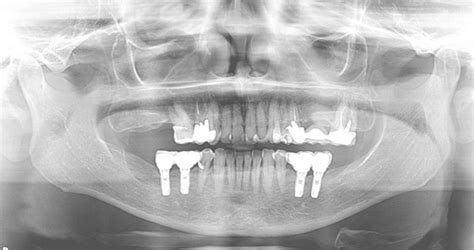 Scielo Brasil Uncommon Bilateral Maxillary Exostosis Case Report