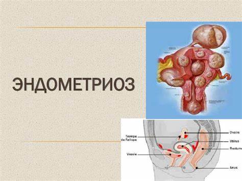 Эндометриоза и диета Эндометриоз - презентация онлайн Эндометриоз - презентация онлайн Эндометриоза и диета