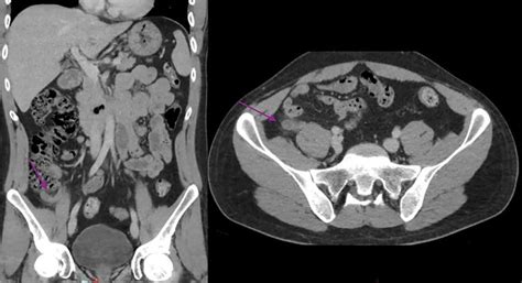 Abdominal Ct Scan Showing A Dilated And Thickened Appendix With