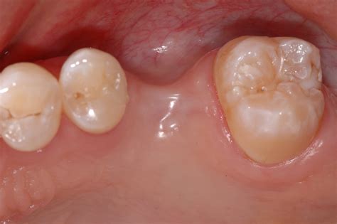 Replacement Of A Missing First Left Maxillary Molar Following Tooth
