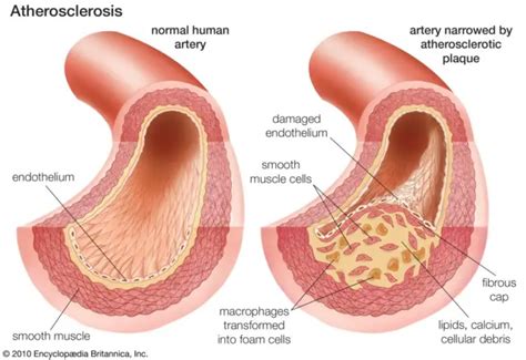 Atherosclerosis Overview Causes Symptoms And Treatment Healthtian