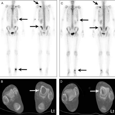 Bone Scintigraphy And Ct Before And After Za Therapy A Bone