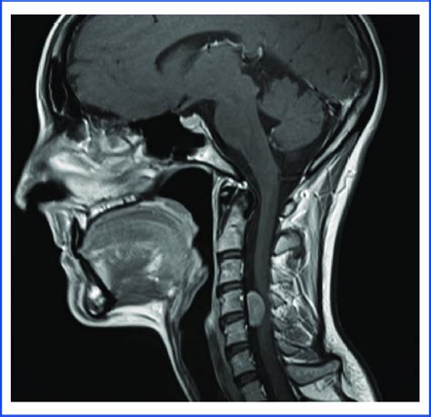 Sagittal Preoperative Mri Of The Cervical Spine With Contrast
