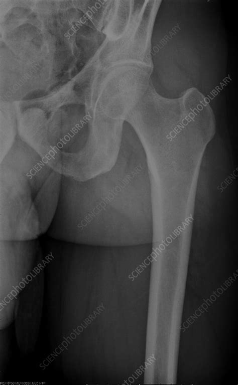 Normal femur, X-ray - Stock Image - C039/3287 - Science Photo Library