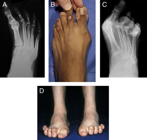Diagnosis And Treatment Of Forefoot Disorders Section 1 Digital