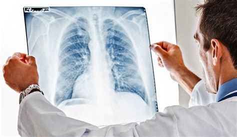 Study Drug Has Long Term Survival Benefit For Some Lung Cancer