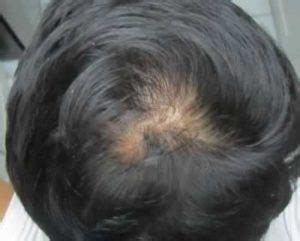 【写真あり】つむじはげの判断基準｜正常なつむじとの違いは ...