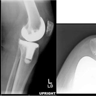 Radiographs Of Case Who Presented With A Painful Total Knee Download Scientific Diagram
