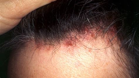 Scalp Folliculitis Symptoms Pictures Causes Shampoos And Creams