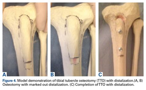 Tibial Tuberosity Osteotomy