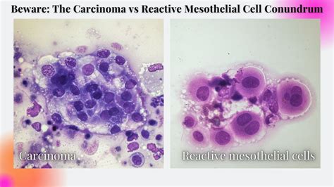 The Carcinoma Vs Reactive Mesothelial Cell Conundrum
