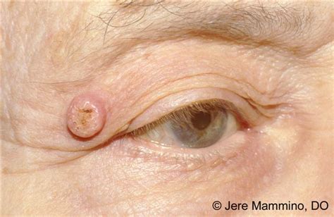 Keratoacanthoma — Ophthalmology Review