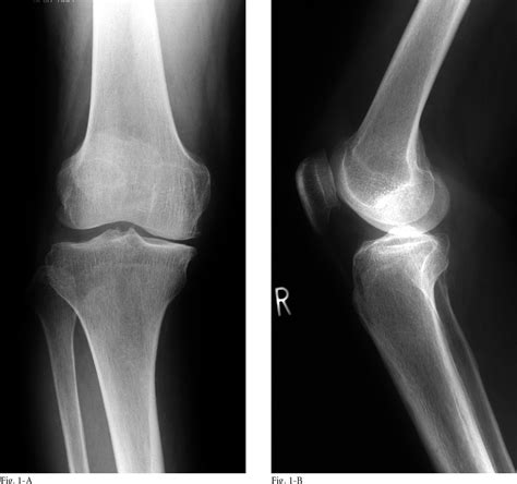 Figure 1 From Opening Wedge Osteotomy For Revision Of Failed Closing