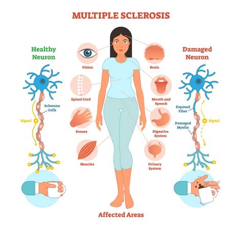 Symptoms Of Multiple Sclerosis You Cant See Sheltering Arms Institute
