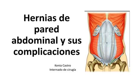 Hernias De Pared Abdominal Y Sus Complicaciones Alejandra Reyes Udocz