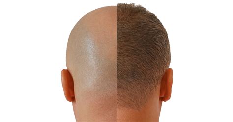 What To Expect After A Hair Transplant Maxim Hair Restoration