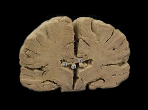 Coronal Section Of Brain Plastinated Specimensanatomy Modelanatomy