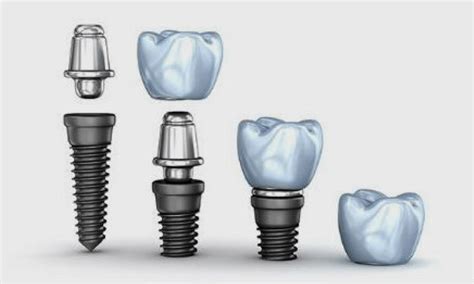 ¿cuántos Tipos De Implantes Dentales Hay Clínica Dental Everest