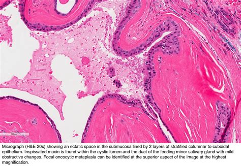Cyst Floor Of Mouth Pathology