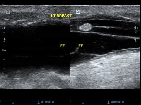 Post Mastectomy Seroma Image