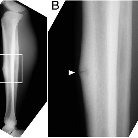 Lateral Radiograph Of Anterior Mid Tibia Stress Fracture A High My