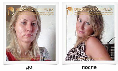 «Демодекс Комплекс®» Вечерний крем от демодекоза (Синьшэн) - Demodex Картинка - «Демодекс Комплекс®» Вечерний крем от демодекоза (Синьшэн) - Demodex