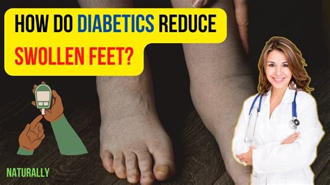 How Do Diabetics Reduce Swollen Feet The Natural Way Youtube