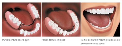 Dentures And Partial Dentures For Tooth Replacement Jpw Dental