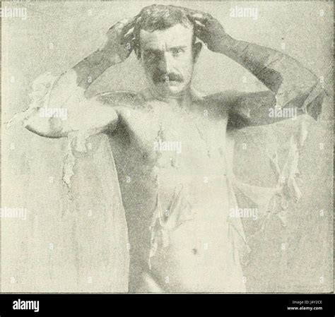 Hermaphroditismus Beim Menschen 1908 Stockfotografie Alamy