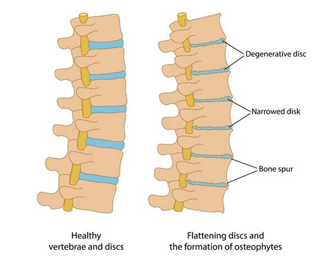 Physiotherapy Treatment For Degenerative Disc Disease Ddd Part
