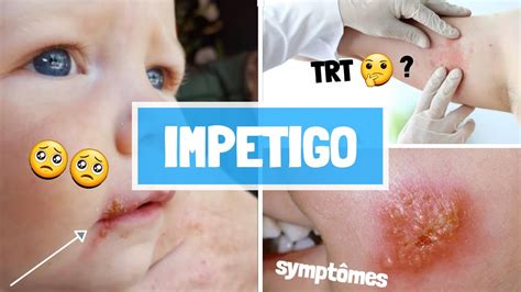 Impetigo Causes Sypmtomes Complications Traitement Youtube