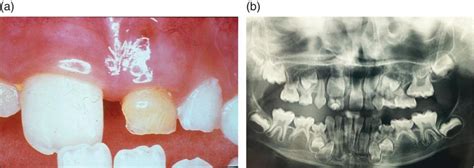 Eruption Disturbances Of Teeth Etiology And Diagnosis Pocket Dentistry