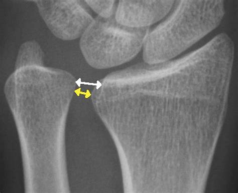Figure From Distal Radioulnar Joint Stress Radiography For Detecting Radioulnar Ligament