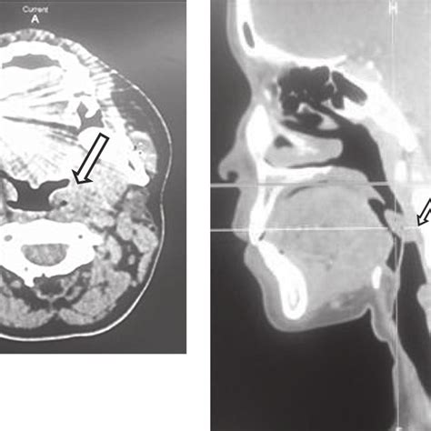 Pdf Hamartomatous Polyp Of The Palatine Tonsil A Case Report