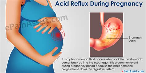 But fortunately, there are proven ways to get relief. Acid Reflux During Pregnancy: Home Remedies and Lifestyle ...