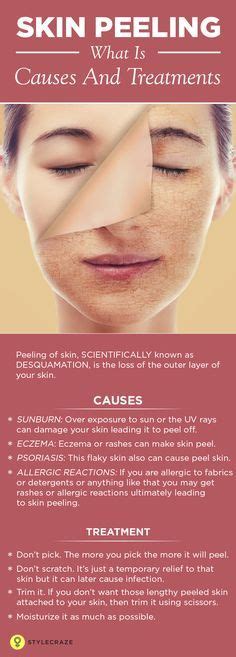 Skin Peeling Causes Symptoms And How To Reduce It Peeling Skin