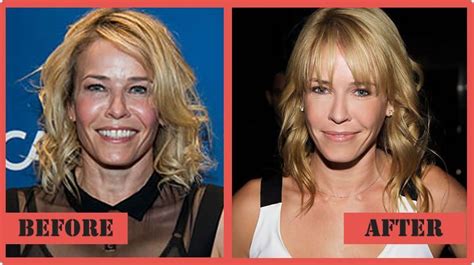 Chelsea Handler Plastic Surgery How True Is The Claim Celebrity