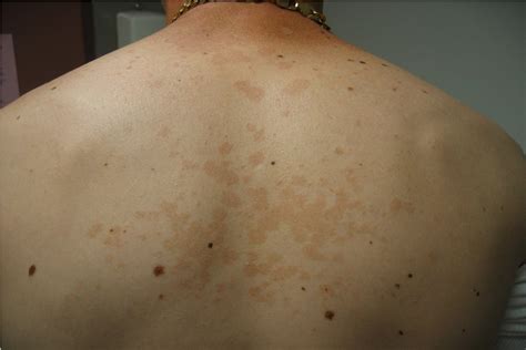 Harbor Hospital Residents Pow 40 Yrs Old With Rash On His Back
