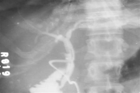 Postoperative T Tube Cholangiogram Of Case 2 Showing Normal Flow Of The